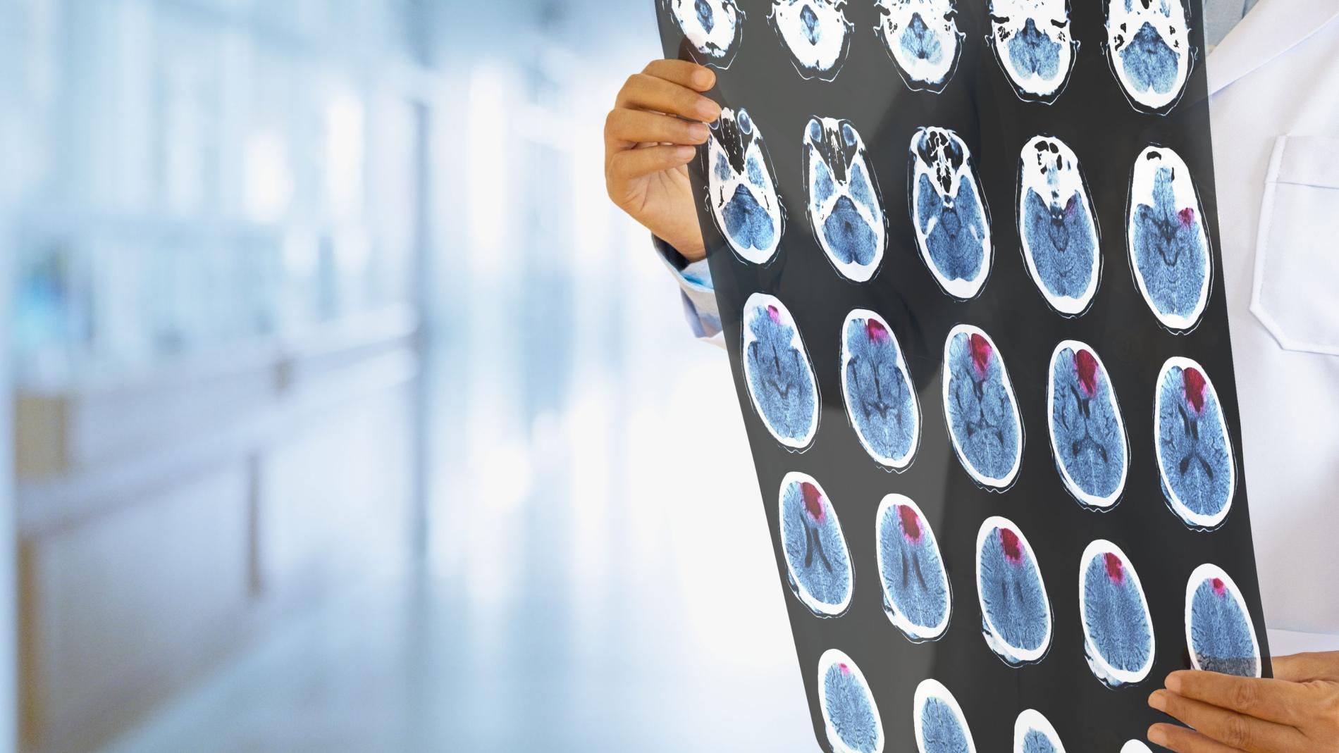 Estudi de genètica i ictus