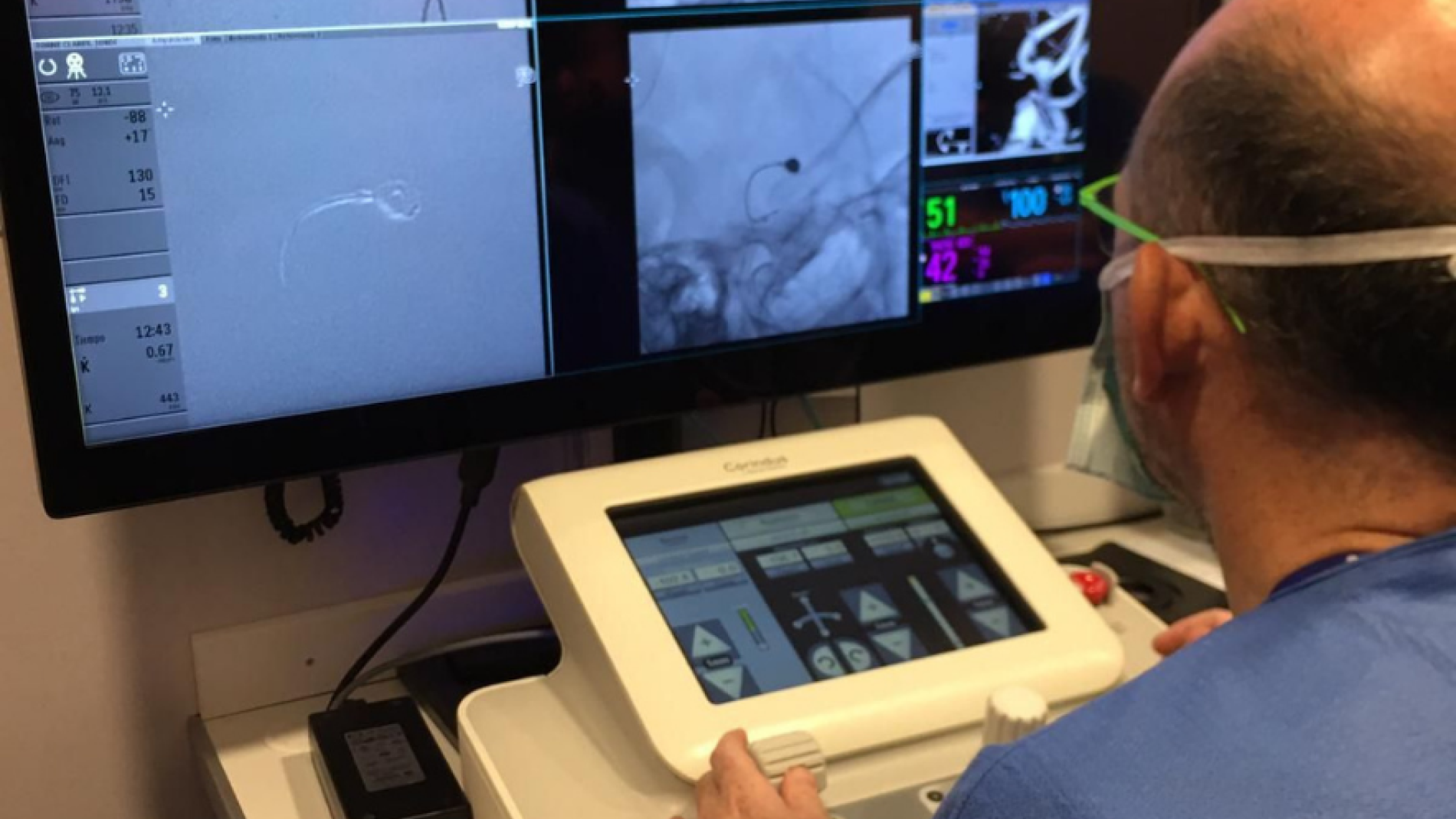 Vall d'Hebron tests robotic thrombectomy for stroke with a pioneering ...